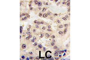 Formalin-fixed and paraffin-embedded human lung carcinoma tissue reacted with EN1 polyclonal antibody  , which was peroxidase-conjugated to the secondary antibody, followed by DAB staining. (EN1 anticorps  (N-Term))