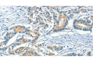 Immunohistochemistry of paraffin-embedded Human colon cancer using ASAH2 Polyclonal Antibody at dilution of 1:50