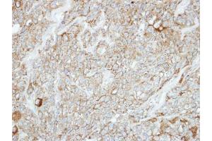IHC-P Image Immunohistochemical analysis of paraffin-embedded BT474 xenograft, using PCDH1, antibody at 1:100 dilution.
