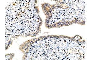 Phospho-MKK7 (Thr275) Antibody at 1/100 staining Human ovarian cancer and adjacent normal tissues by IHC-P.