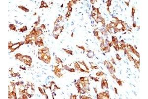 Formalin-fixed, paraffin-embedded human breast carcinoma stained with HSP27 antibody (HSPB1/774) (HSP27 anticorps)