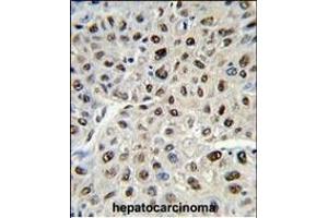 Formalin-fixed and paraffin-embedded human hepatocarcinoma reacted with SSB Antibody (C-term) (ABIN389303 and ABIN2839423) , which was peroxidase-conjugated to the secondary antibody, followed by DAB staining. (SSB anticorps  (C-Term))