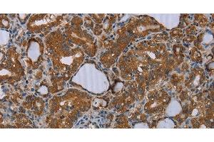 Immunohistochemistry of paraffin-embedded Human thyroid cancer tissue using MEIS1 Polyclonal Antibody at dilution 1:30 (MEIS1 anticorps)