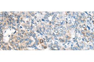 Immunohistochemistry of paraffin-embedded Human liver cancer tissue using CES2 Polyclonal Antibody at dilution of 1:55(x200) (CES2 anticorps)