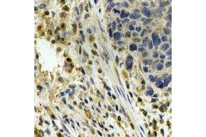 Immunohistochemical analysis of ALDH4A1 staining in human esophageal cancer formalin fixed paraffin embedded tissue section. (ALDH4A1 anticorps)