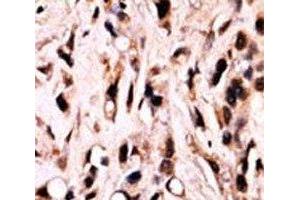 IHC analysis of FFPE breast carcinoma stained with phospho-SMAD4 antibody. (SMAD4 anticorps  (pThr277))