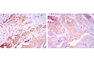 Immunohistochemical analysis of paraffin-embedded rectum cancer tissues (left) and stomach cancer tissues (right) using CEA mouse mAb with DAB staining. (CEA anticorps)