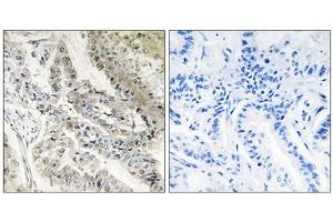 Immunohistochemistry analysis of paraffin-embedded human lung carcinoma tissue, using CRBP III antibody. (Retinol Binding Protein 5 anticorps  (N-Term))