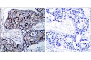 Immunohistochemistry analysis of paraffin-embedded human breast carcinoma tissue, using Integrin beta3 (Ab-785) Antibody. (Integrin beta 3 anticorps  (AA 739-788))