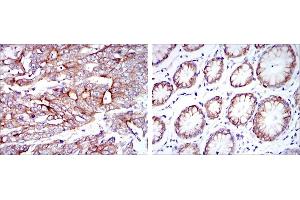 Immunohistochemical analysis of paraffin-embedded stomach cancer tissues (left) and stomach tissues (right) using KRT19 mouse mAb with DAB staining. (Cytokeratin 19 anticorps)
