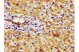 Immunohistochemistry of paraffin-embedded human liver cancer using ABIN7145059 at dilution of 1:100 (NPR3 anticorps  (AA 36-127))