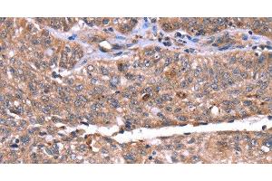 Immunohistochemistry of paraffin-embedded Human ovarian cancer tissue using HRG Polyclonal Antibody at dilution 1:50 (HRG anticorps)