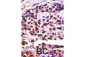 Formalin-fixed and paraffin-embedded human cancer tissue reacted with the primary antibody, which was peroxidase-conjugated to the secondary antibody, followed by DAB staining.