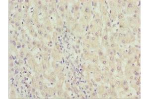 Immunohistochemistry of paraffin-embedded human liver cancer using ABIN7176530 at dilution of 1:100 (ZNF785 anticorps  (AA 1-200))