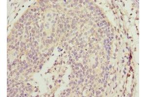 Immunohistochemistry of paraffin-embedded human cervical cancer using ABIN7143769 at dilution of 1:100