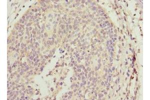 Immunohistochemistry of paraffin-embedded human cervical cancer using ABIN7143769 at dilution of 1:100 (ALG2 anticorps  (AA 197-416))