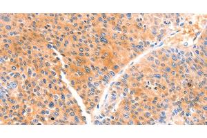 Immunohistochemistry of paraffin-embedded Human liver cancer using PRDX2 Polyclonal Antibody at dilution of 1:80