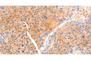 Immunohistochemistry of paraffin-embedded Human liver cancer using PRDX2 Polyclonal Antibody at dilution of 1:80 (Peroxiredoxin 2 anticorps)