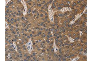 The image on the left is immunohistochemistry of paraffin-embedded Human liver cancer tissue using ABIN7129190(DEGS1 Antibody) at dilution 1/40, on the right is treated with fusion protein. (DEGS1 anticorps)