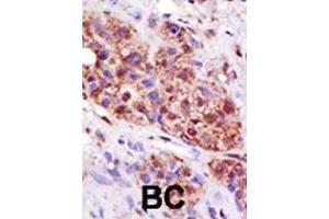 Formalin-fixed and paraffin-embedded human cancer tissue reacted with the primary antibody, which was peroxidase-conjugated to the secondary antibody, followed by DAB staining. (UBE2B anticorps  (C-Term))