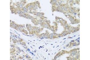 Immunohistochemistry of paraffin-embedded Human liver cancer using TIMM10B Polyclonal Antibody at dilution of 1:100 (40x lens). (TIMM10B anticorps)