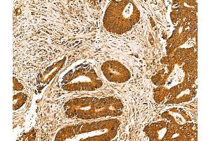 ABIN6261856 and ABIN6266542 at 1/100 staining Human colorectal cancer by IHC-P.