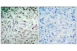 Immunohistochemical analysis of paraffin- embedded human breast carcinoma tissue, using Rb (phospho-Ser780) antibody (E011132) . (Retinoblastoma 1 anticorps  (pSer780))