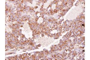 IHC-P Image Immunohistochemical analysis of paraffin-embedded HUH7 xenograft, using RhoGDI, antibody at 1:100 dilution.