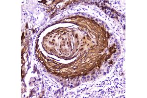 IHC analysis of FABP5 using anti-FABP5 antibody .