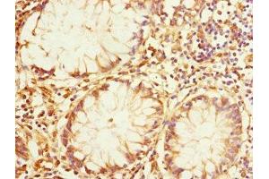 Immunohistochemistry of paraffin-embedded human colon cancer using ABIN7167162 at dilution of 1:100 (IQGAP3 anticorps  (AA 1437-1631))