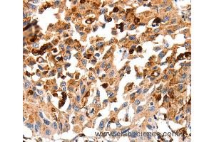 Immunohistochemistry of Human lung cancer using CTSB Polyclonal Antibody at dilution of 1:35 (Cathepsin B anticorps)