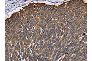 The image on the left is immunohistochemistry of paraffin-embedded Human lung cancer tissue using ABIN7130044(KRT31 Antibody) at dilution 1/30, on the right is treated with fusion protein. (Keratin 31 anticorps)