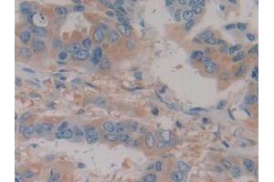 Detection of Hpt in Human Breast cancer Tissue using Polyclonal Antibody to Haptoglobin (Hpt)