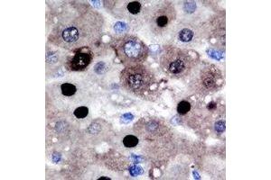 Immunohistochemical analysis of PRMT2 staining in human liver cancer formalin fixed paraffin embedded tissue section.