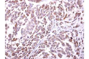 IHC-P Image NKG2D antibody [N3C2], Internal detects NKG2D protein at cytosol on human lung carcinoma by immunohistochemical analysis. (KLRK1 anticorps  (Internal Region))