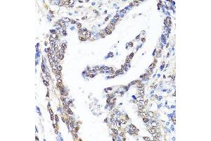 Immunohistochemistry of paraffin-embedded human lung cancer using YAP1 antibody.