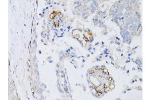 Immunohistochemistry of paraffin-embedded human breast cancer using CD34 antibody. (CD34 anticorps)