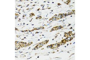 Immunohistochemistry of paraffin-embedded human breast cancer using HSPA9 antibody (ABIN5970207) at dilution of 1/100 (40x lens).