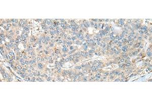 Immunohistochemistry of paraffin-embedded Human liver cancer tissue using CASR Polyclonal Antibody at dilution of 1:60(x200) (CASR anticorps)