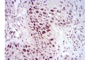 Immunohistochemical analysis of paraffin-embedded esophageal cancer tissues using HDAC10 mouse mAb with DAB staining.