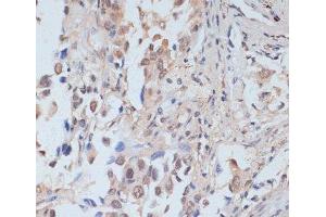 Immunohistochemistry of paraffin-embedded Human lung cancer using Phospho-STAT1(S727) Polyclonal Antibody at dilution of 1:100 (40x lens).