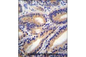 HSD11B1L Antibody immunohistochemistry analysis in formalin fixed and paraffin embedded human prostate carcinoma followed by peroxidase conjugation of the secondary antibody and DAB staining.