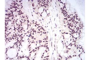 Immunohistochemical analysis of paraffin-embedded colon cancer tissues using DNMT1 mouse mAb with DAB staining.
