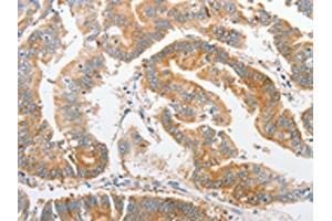 The image on the left is immunohistochemistry of paraffin-embedded Human colon cancer tissue using ABIN7128369(ALPI Antibody) at dilution 1/25, on the right is treated with fusion protein.