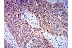 Immunohistochemical analysis of paraffin-embedded cervical cancer tissues using BAX mouse mAb with DAB staining. (BAX anticorps  (AA 13-160))