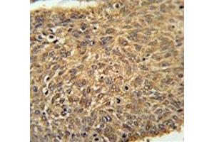 ATG13 antibody immunohistochemistry analysis in formalin fixed and paraffin embedded human lung carcinoma.