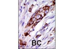 Formalin-fixed and paraffin-embedded human cancer tissue reacted with the primary antibody, which was peroxidase-conjugated to the secondary antibody, followed by DAB staining.
