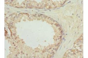 Immunohistochemistry of paraffin-embedded human prostate cancer using ABIN7153465 at dilution of 1:100 (LGALS8 anticorps  (AA 20-317))