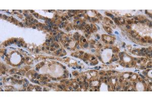 Immunohistochemistry of paraffin-embedded Human thyroid cancer using GGCX Polyclonal Antibody at dilution of 1:50 (GGCX anticorps)