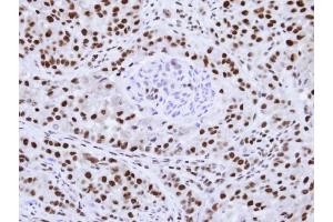 Immunohistochemical staining of paraffin-embedded A549 Xenograft using hnRNP F antibody at a dilution of 1:100 (HNRNPF anticorps)